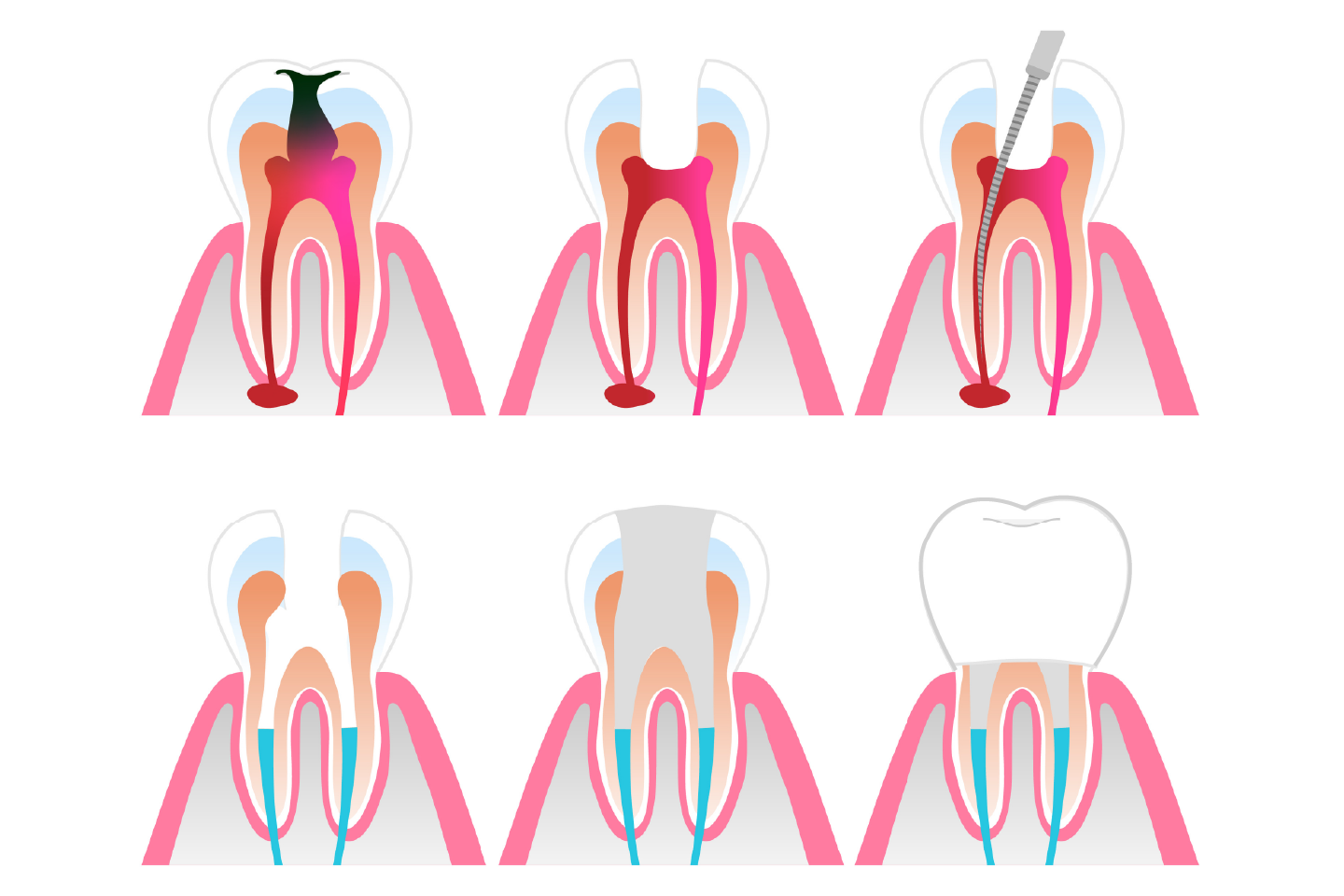 Vital Pulp Therapy in Singapore | Alpha Dental Group